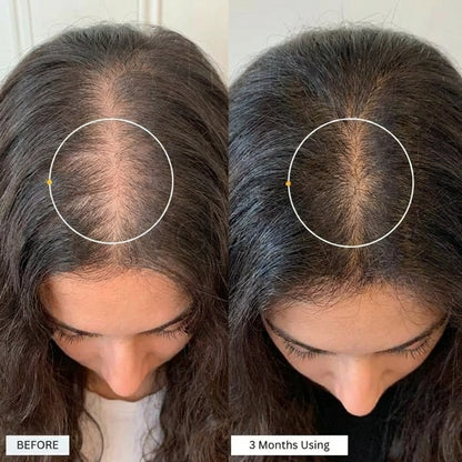 SheRise™ PCOS Hair Spray